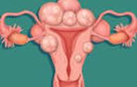 Fibroids