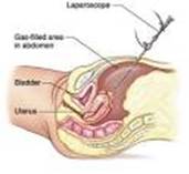 Keyhole Surgery